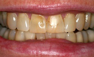 Front teeth with dark lines