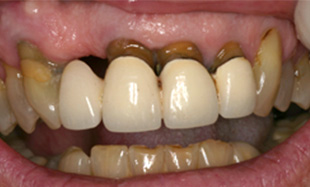 Smile with failing teeth and dark discoloration at gums