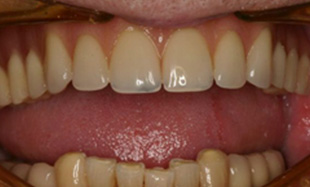 Fully restored healthy smile