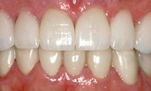 Fully restored bright white smile