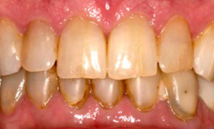 Stained and decayed teeth