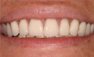 Replaced tooth and brightened smile