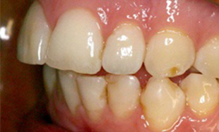 Teeth with yellow spots