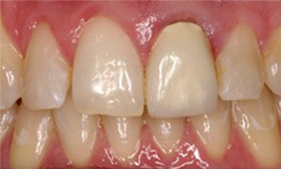 Smile with darkened and inflamed gums