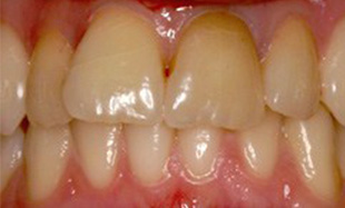 Discolored and misshapen front teeth