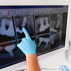 Digital dental x-rays on monitor