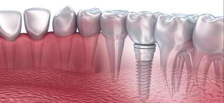 Animation of dnetal implant