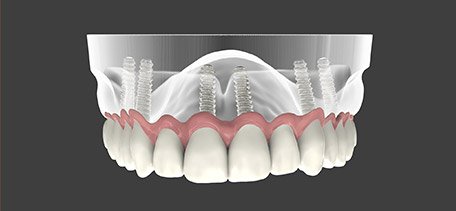 Animation of implant supported denture