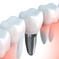 Animation of implant supported dental crown