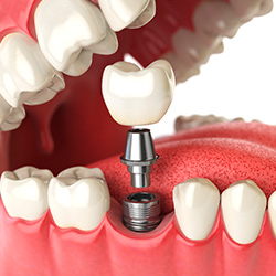 Animation of the implant placement process