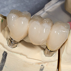 Model smile with implant bridge