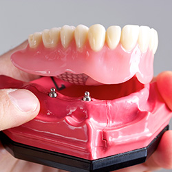 Model of implant supported denture