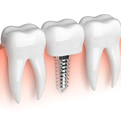 Animation of mini dental implant