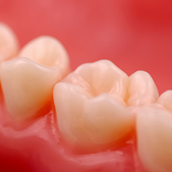 closeup of tooth with fillings