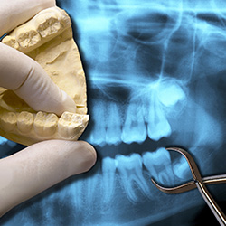 X-ray and model of teeth to be repaired