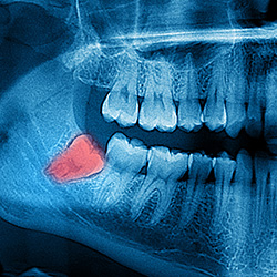 X-ray with wisdom tooth high lighted