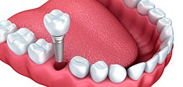 Animation of implant supported dental crown